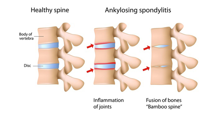 Ankylosing Spondylitis Diagram