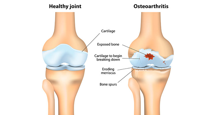 Osteoarthritis Diagram