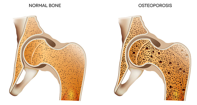 Osteoporosis Diagram