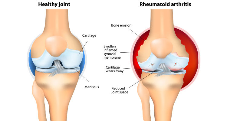 Rheumatoid Arthritis Diagram