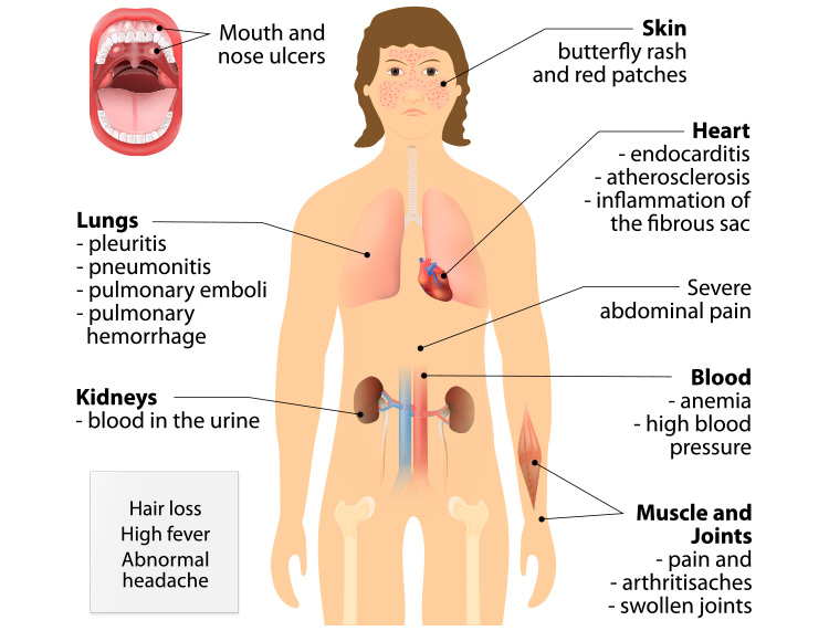 Systemic Lupus Erythematosus Diagram