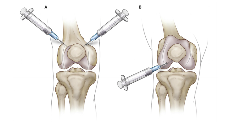 Viscosupplementation Diagram