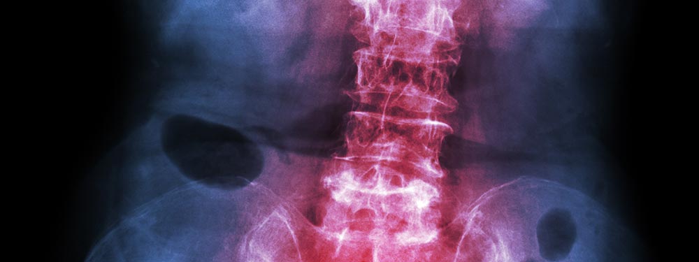 Ankylosing Spondylitis