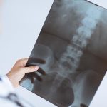 Osteoporosis Treatment